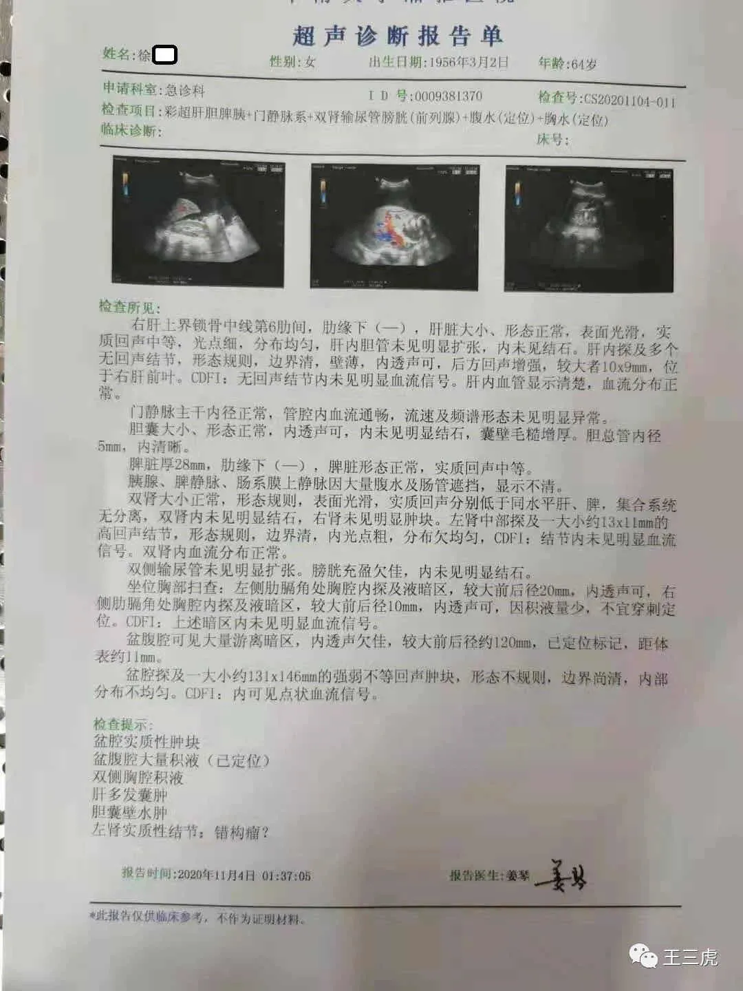 王三虎教授治療卵巢癌腹水醫案